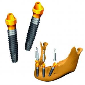 Implantul dentar