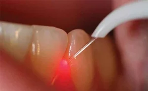 Laserul in parodontoza - un laser roşu acţionează asupra gingiei